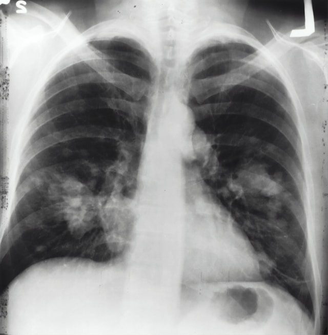 Mesothelioma attorney 